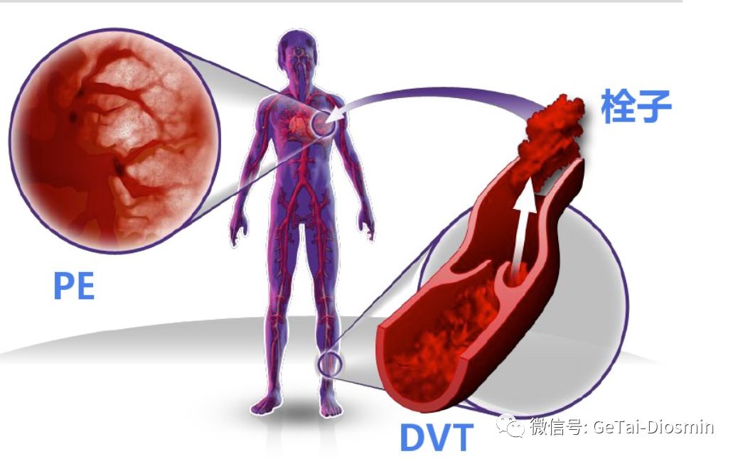 宅家共同抗“疫”新冠肺炎，尚需警惕“隐形杀手”VTE
