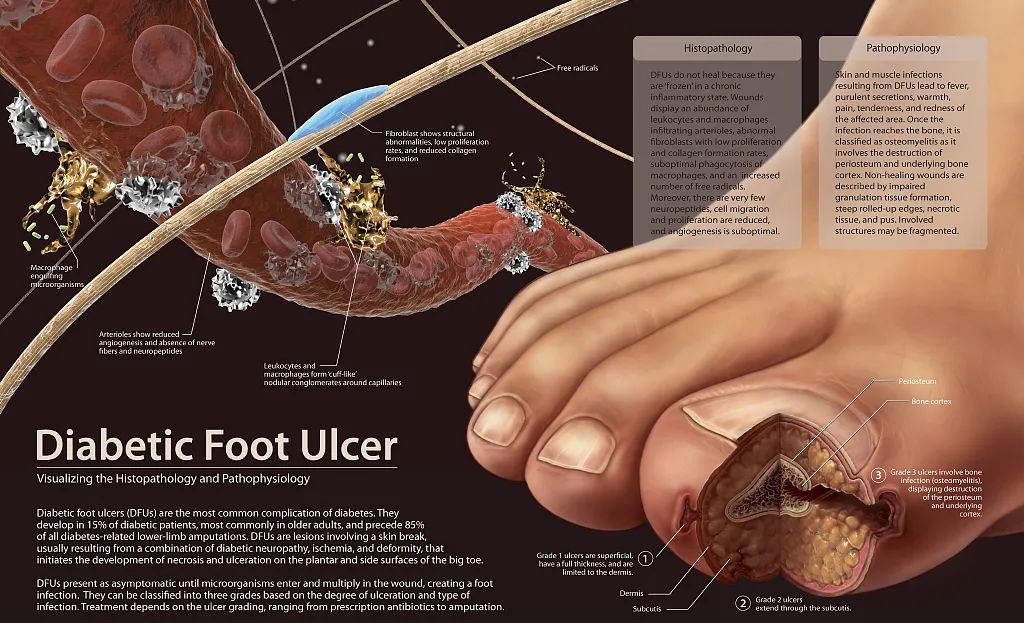 重磅！葛泰再传捷报：糖尿病足领域指南又添新证