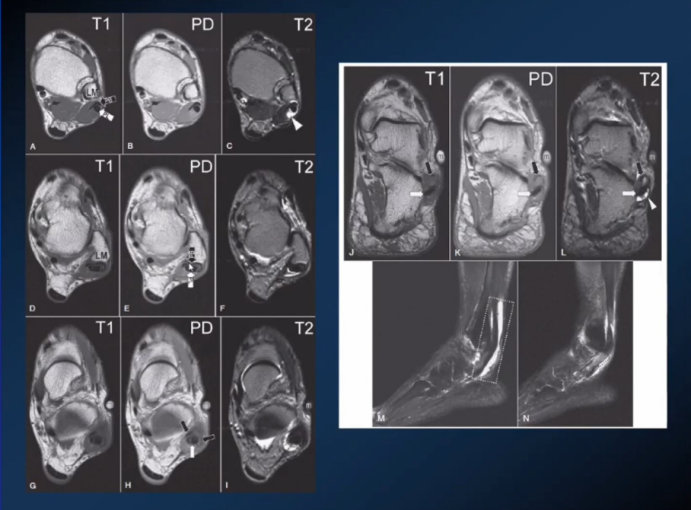 【专家视角】《后踝关节疼痛的MRI》 — 陈爽教授