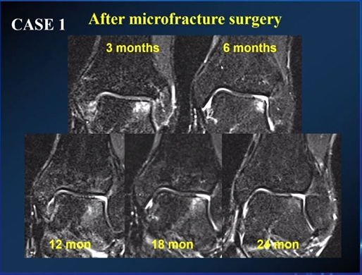 【专家视角】《后踝关节疼痛的MRI》 — 陈爽教授