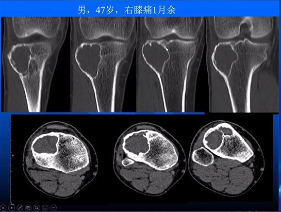 【专家视角】《关节周围囊状骨破坏的诊断与鉴别》 — 田军教授