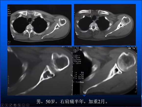 【专家视角】《关节周围囊状骨破坏的诊断与鉴别》 — 田军教授