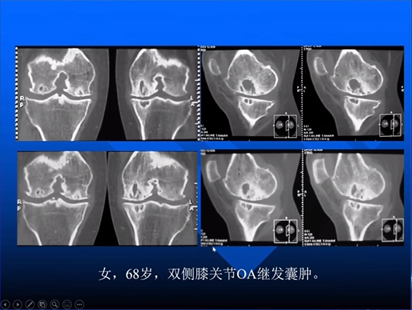 【专家视角】《关节周围囊状骨破坏的诊断与鉴别》 — 田军教授