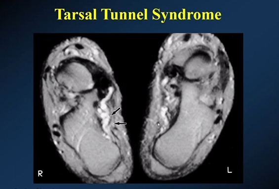 【专家视角】《后踝关节疼痛的MRI》 — 陈爽教授