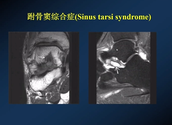 【专家视角】《后踝关节疼痛的MRI》 — 陈爽教授