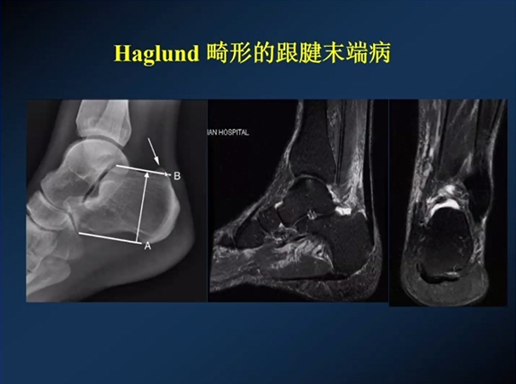 【专家视角】《后踝关节疼痛的MRI》 — 陈爽教授