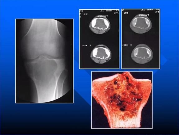 【专家视角】《关节周围囊状骨破坏的诊断与鉴别》 — 田军教授