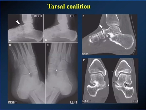 【专家视角】《后踝关节疼痛的MRI》 — 陈爽教授