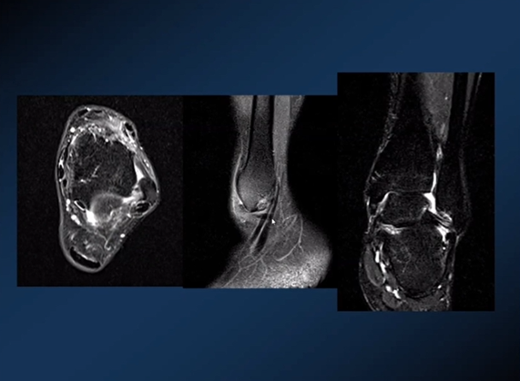 【专家视角】《后踝关节疼痛的MRI》 — 陈爽教授