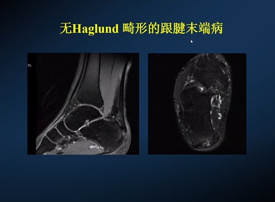 【专家视角】《后踝关节疼痛的MRI》 — 陈爽教授