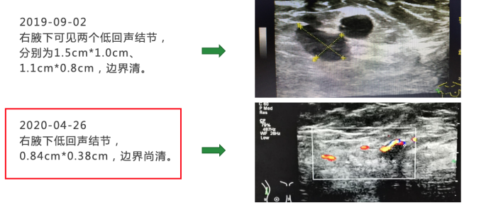 【好西例】西达本胺+内分泌治疗用于HR+/HER2-晚期乳腺癌，有效克服内分泌耐药