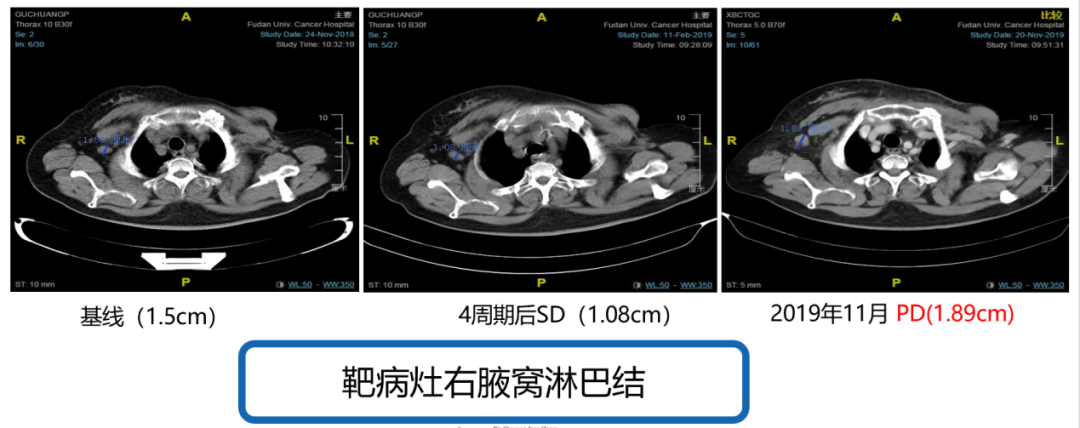 【好西例】西达本胺对CDK4/6抑制剂联合方案耐药后效果显著案例——淋巴结转移灶缩小达CR，不低于15个月PFS