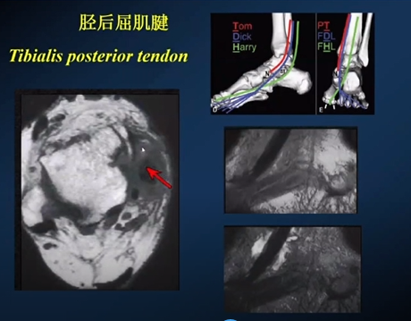 【专家视角】《后踝关节疼痛的MRI》 — 陈爽教授