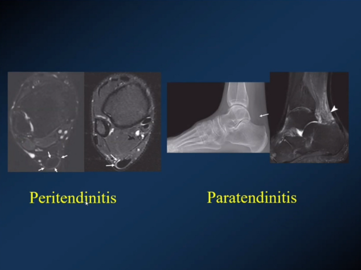 【专家视角】《后踝关节疼痛的MRI》 — 陈爽教授