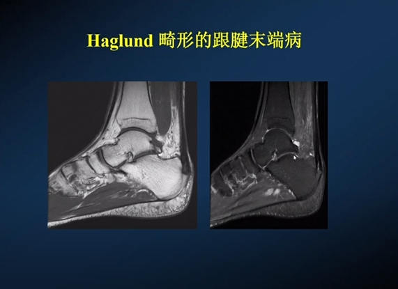 【专家视角】《后踝关节疼痛的MRI》 — 陈爽教授