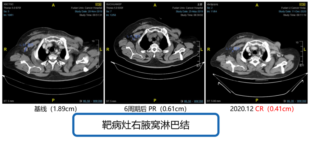 【好西例】西达本胺对CDK4/6抑制剂联合方案耐药后效果显著案例——淋巴结转移灶缩小达CR，不低于15个月PFS