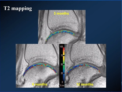 【专家视角】《后踝关节疼痛的MRI》 — 陈爽教授