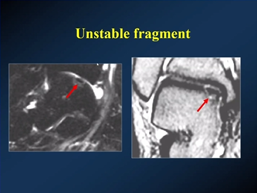 【专家视角】《后踝关节疼痛的MRI》 — 陈爽教授