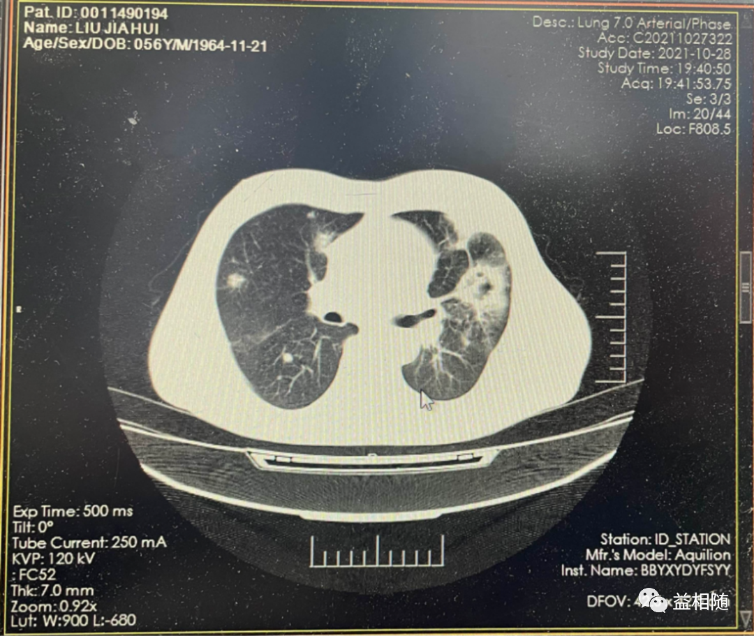 AML容易忽视的感染难点——毛霉菌感染