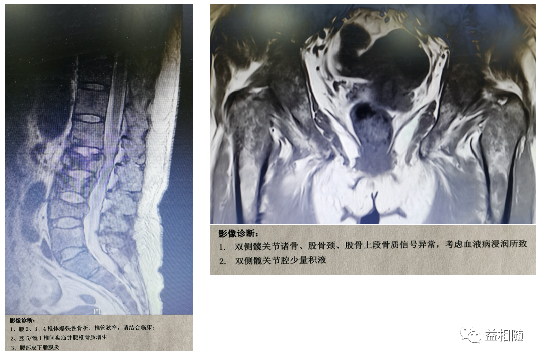 1例新诊断高危骨髓瘤患者的诊疗经过分享