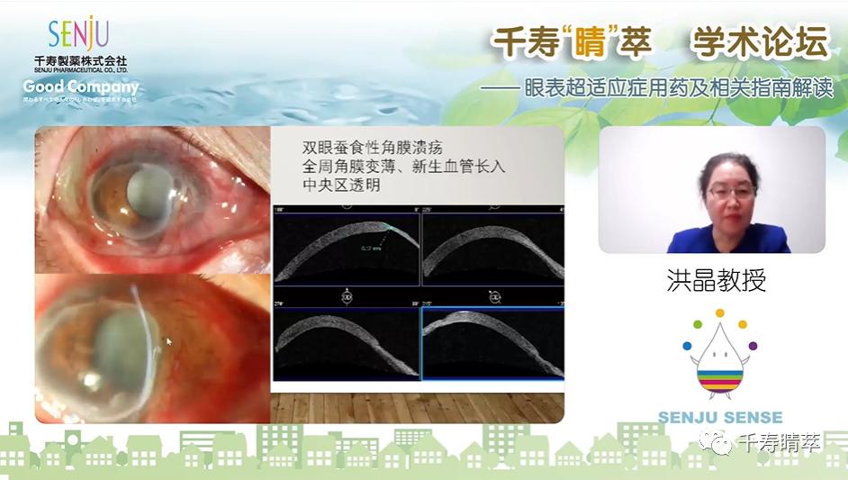 直播回看|千寿“睛”萃学术论坛--眼表超适应症用药及相关指南解读