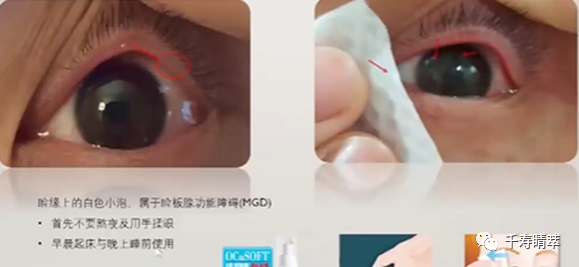 直播回看|千寿“睛”萃学术论坛--眼表超适应症用药及相关指南解读