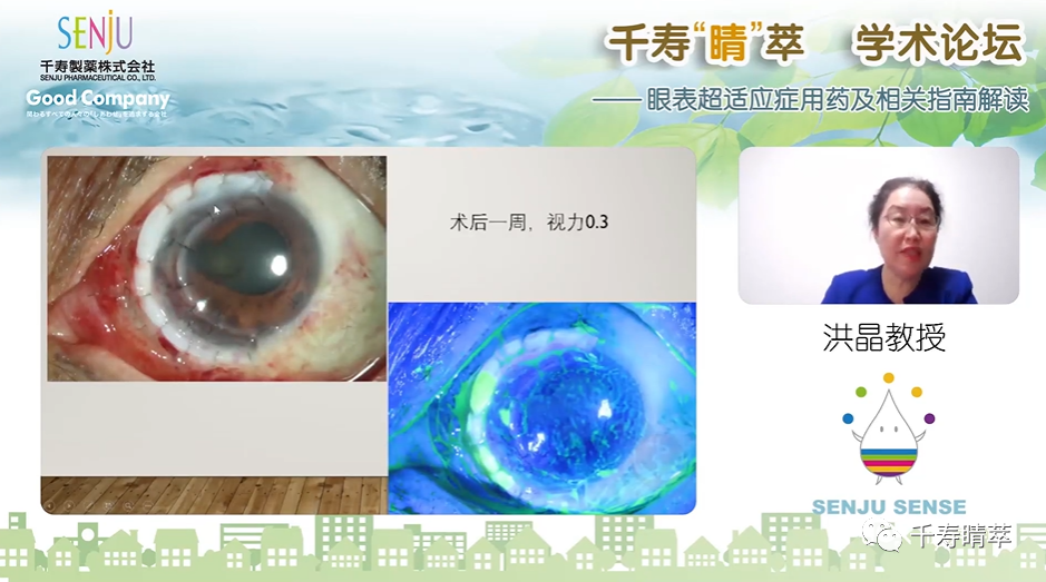 直播回看|千寿“睛”萃学术论坛--眼表超适应症用药及相关指南解读