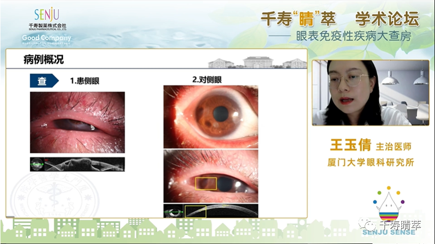 直播回看：千寿‘晴’萃 学术论坛——眼表免疫性疾病大查房