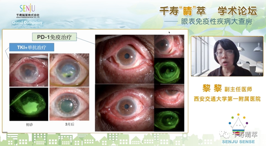 直播回看：千寿‘晴’萃 学术论坛——眼表免疫性疾病大查房