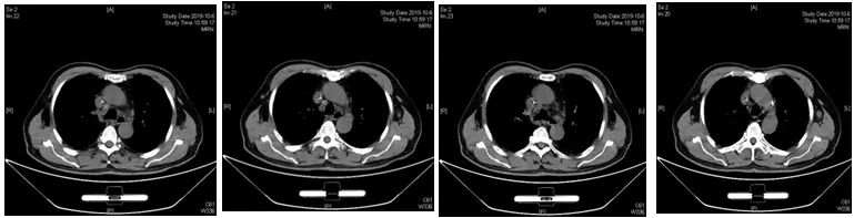 好西例丨老年体弱不耐受常规化疗的高危DLBCL患者，接受R-CRER方案治疗一例