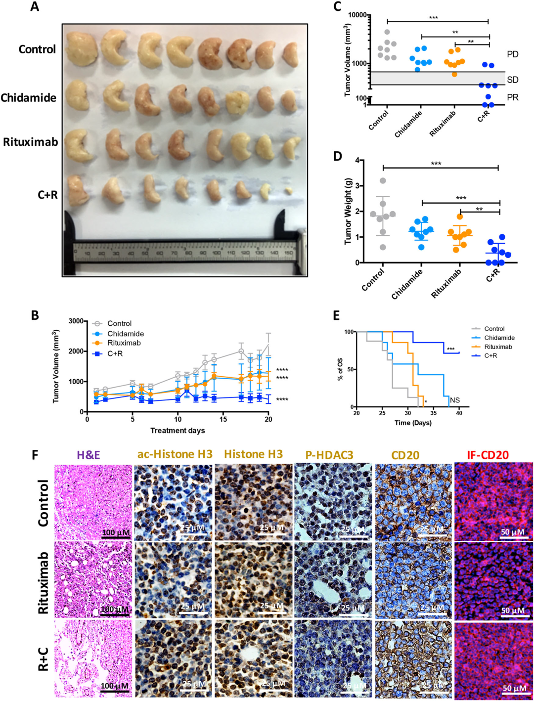 好西例丨老年体弱不耐受常规化疗的高危DLBCL患者，接受R-CRER方案治疗一例