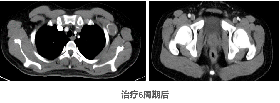 好西例|西达本胺有效治疗一例三打击合并双表达同时伴表观遗传异常的移植后复发DLBCL