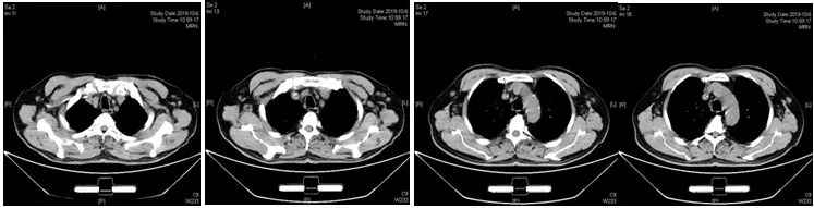 好西例丨老年体弱不耐受常规化疗的高危DLBCL患者，接受R-CRER方案治疗一例