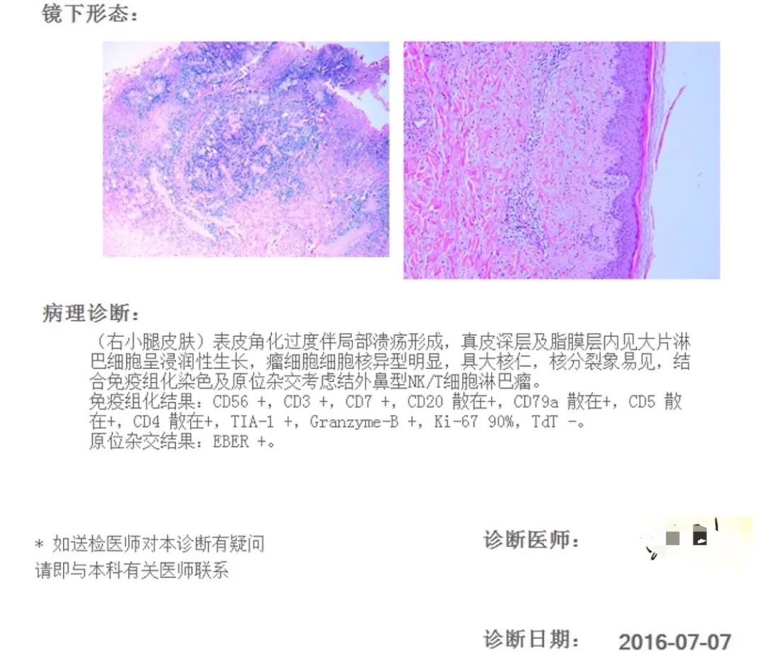 病例分享 | 信迪利单抗联合西达本胺治疗复发难治性结外NK/T细胞淋巴瘤一例