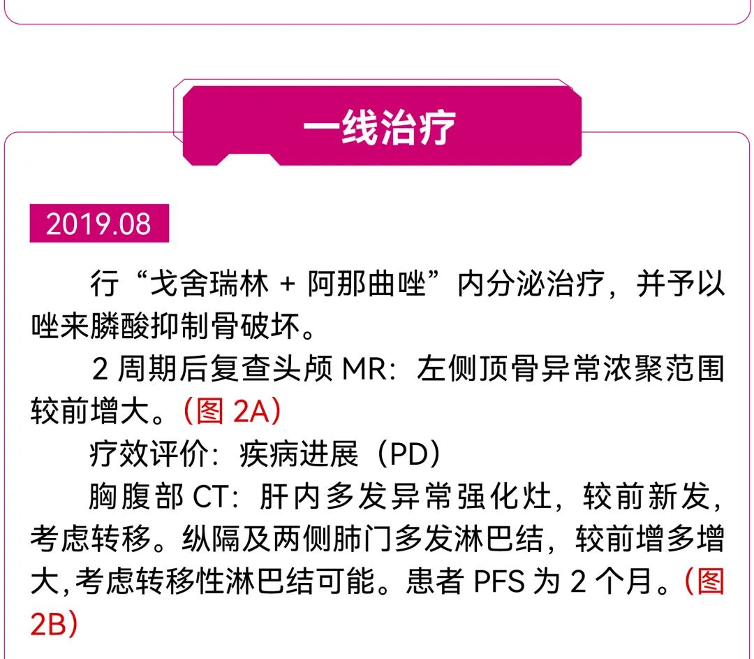 【好西例】PFS大于17个月!西达本胺联合内分泌为CDK4/6i经治患者带来显著获益
