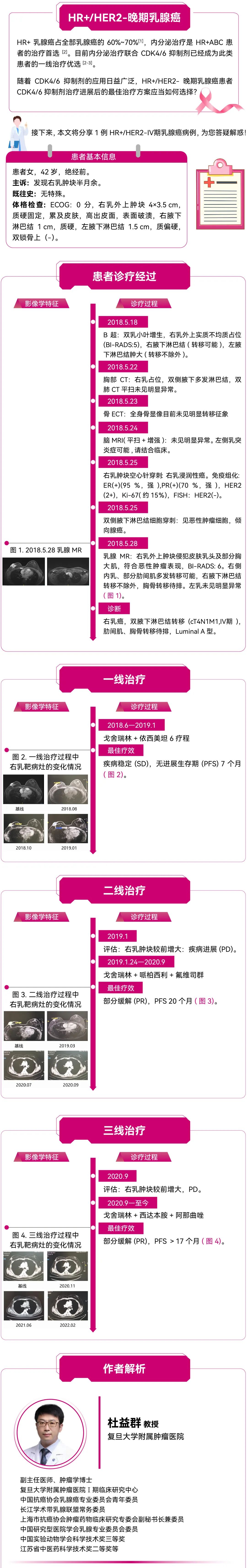 【好西例】PFS超过17个月，西达本胺为CDK4/6抑制剂经治患者带来超长获益