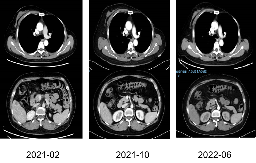 【好西例】PFS大于17个月!西达本胺联合内分泌为CDK4/6i经治患者带来显著获益