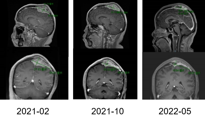 【好西例】PFS大于17个月!西达本胺联合内分泌为CDK4/6i经治患者带来显著获益