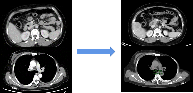 【好西例】PFS大于17个月!西达本胺联合内分泌为CDK4/6i经治患者带来显著获益
