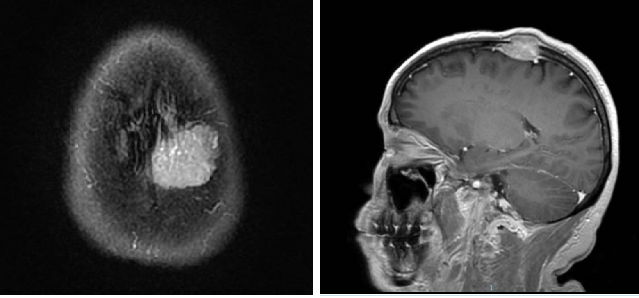 【好西例】PFS大于17个月!西达本胺联合内分泌为CDK4/6i经治患者带来显著获益