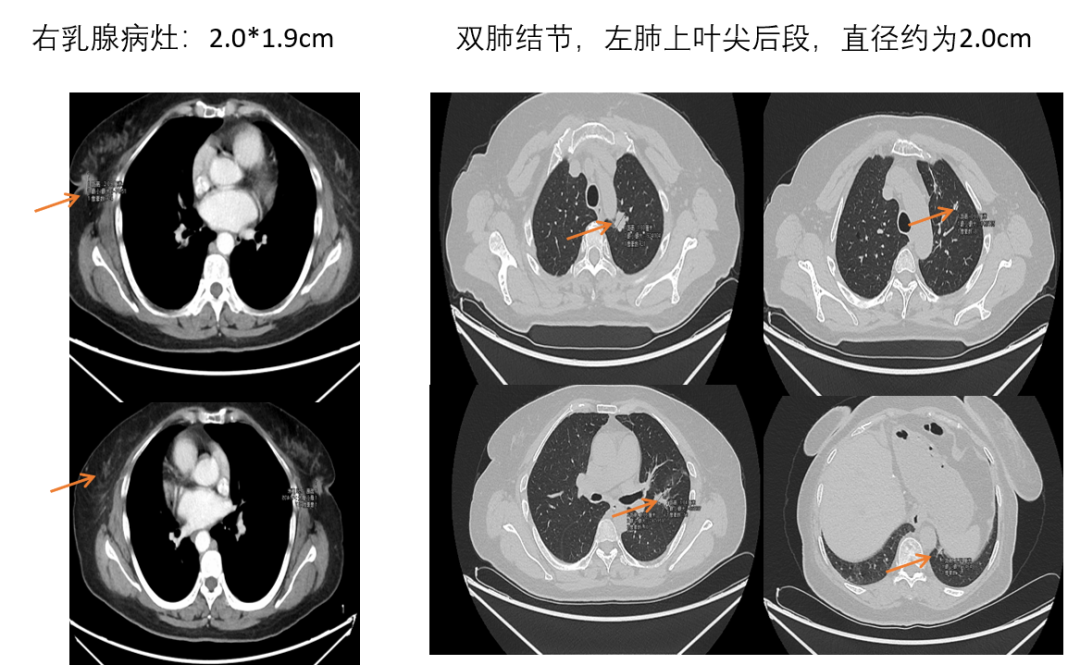 【好西例】HDACi西达本胺+氟维司群用于一线CDK4/6i进展后病例分享