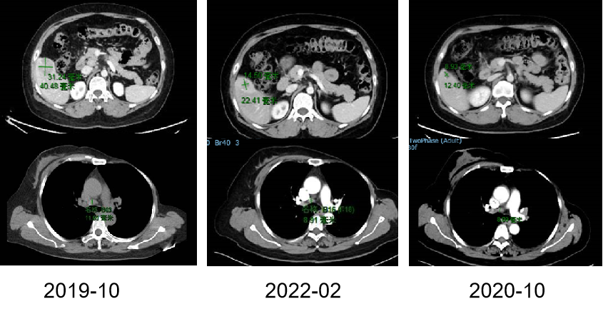 【好西例】PFS大于17个月!西达本胺联合内分泌为CDK4/6i经治患者带来显著获益