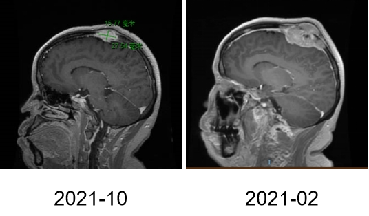 【好西例】PFS大于17个月!西达本胺联合内分泌为CDK4/6i经治患者带来显著获益