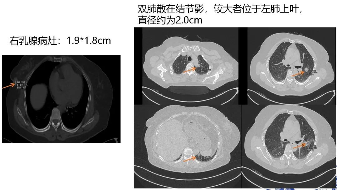 【好西例】HDACi西达本胺+氟维司群用于一线CDK4/6i进展后病例分享