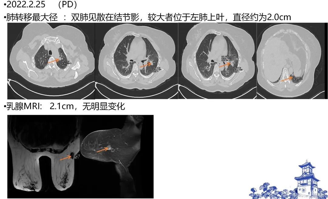 【好西例】HDACi西达本胺+氟维司群用于一线CDK4/6i进展后病例分享