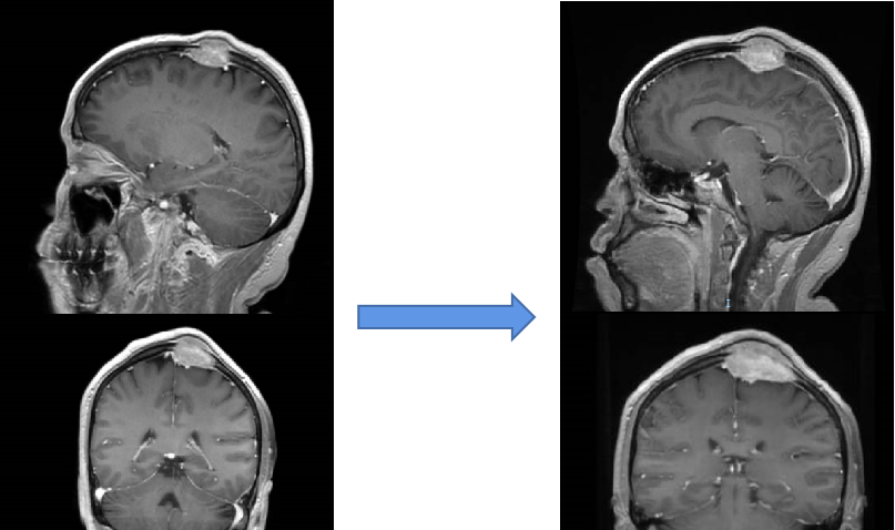 【好西例】PFS大于17个月!西达本胺联合内分泌为CDK4/6i经治患者带来显著获益