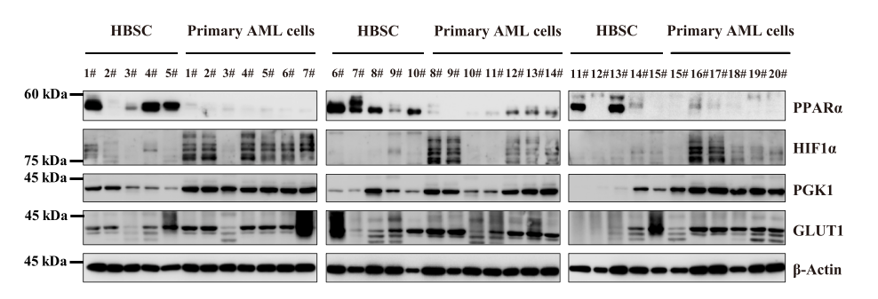 徐兵教授：PPARα-HIF1α-PGK1 信号通路有望成为治疗AML干祖细胞的新靶点