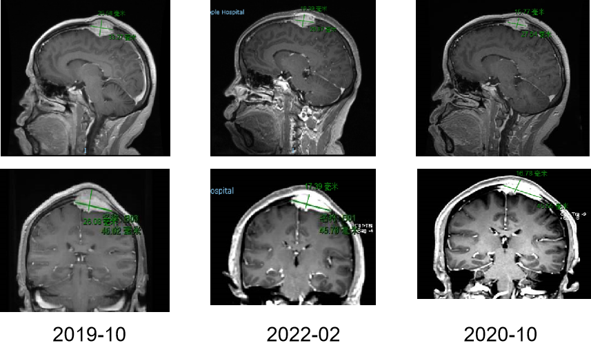【好西例】PFS大于17个月!西达本胺联合内分泌为CDK4/6i经治患者带来显著获益