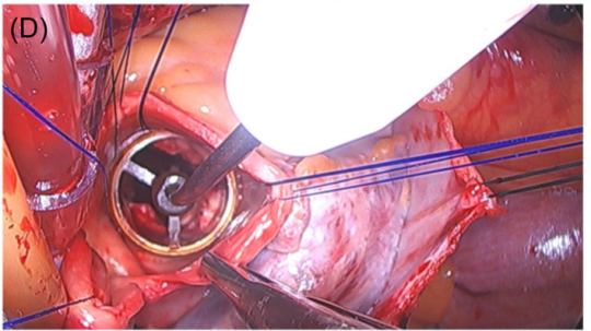 【文献速递】免缝合瓣膜在保留胸骨入路、二叶化主动脉瓣患者中的临床应用