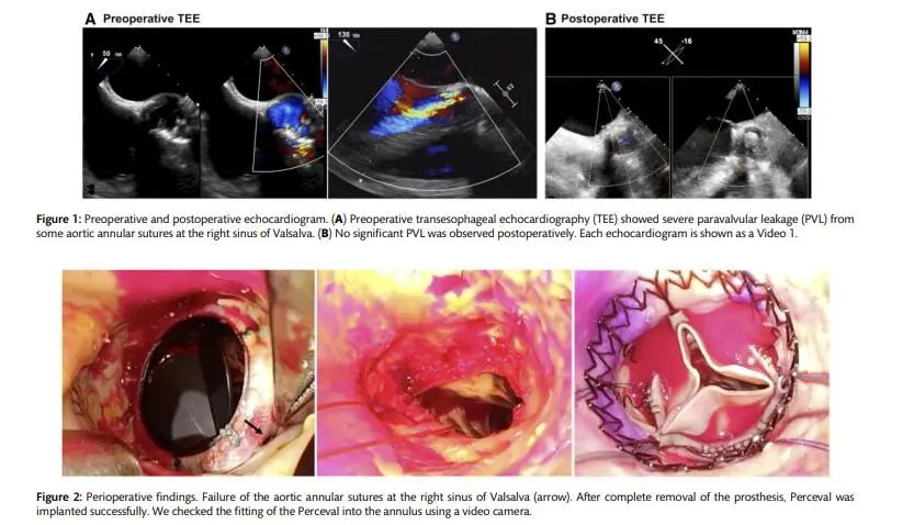 使用Perceval再次主动脉瓣置换成功治疗多次复发性人工瓣膜功能障碍的患者